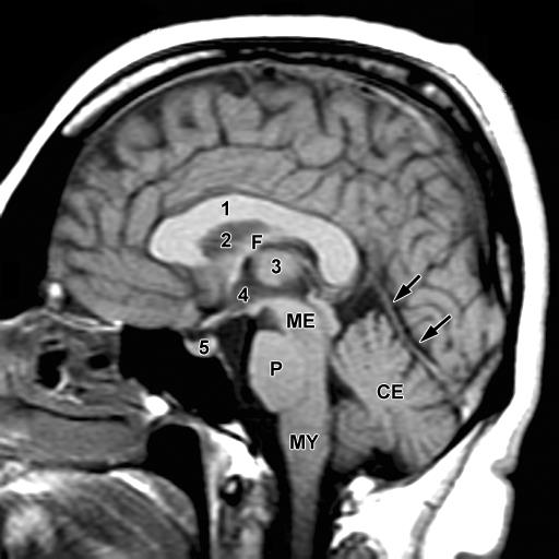 A CEREBELLUM (CE) RADIOLÓGIAI ÁBRÁZOLÁSA. A NYILAK A TENTORIUM CEREBELLI-T JELZIK.