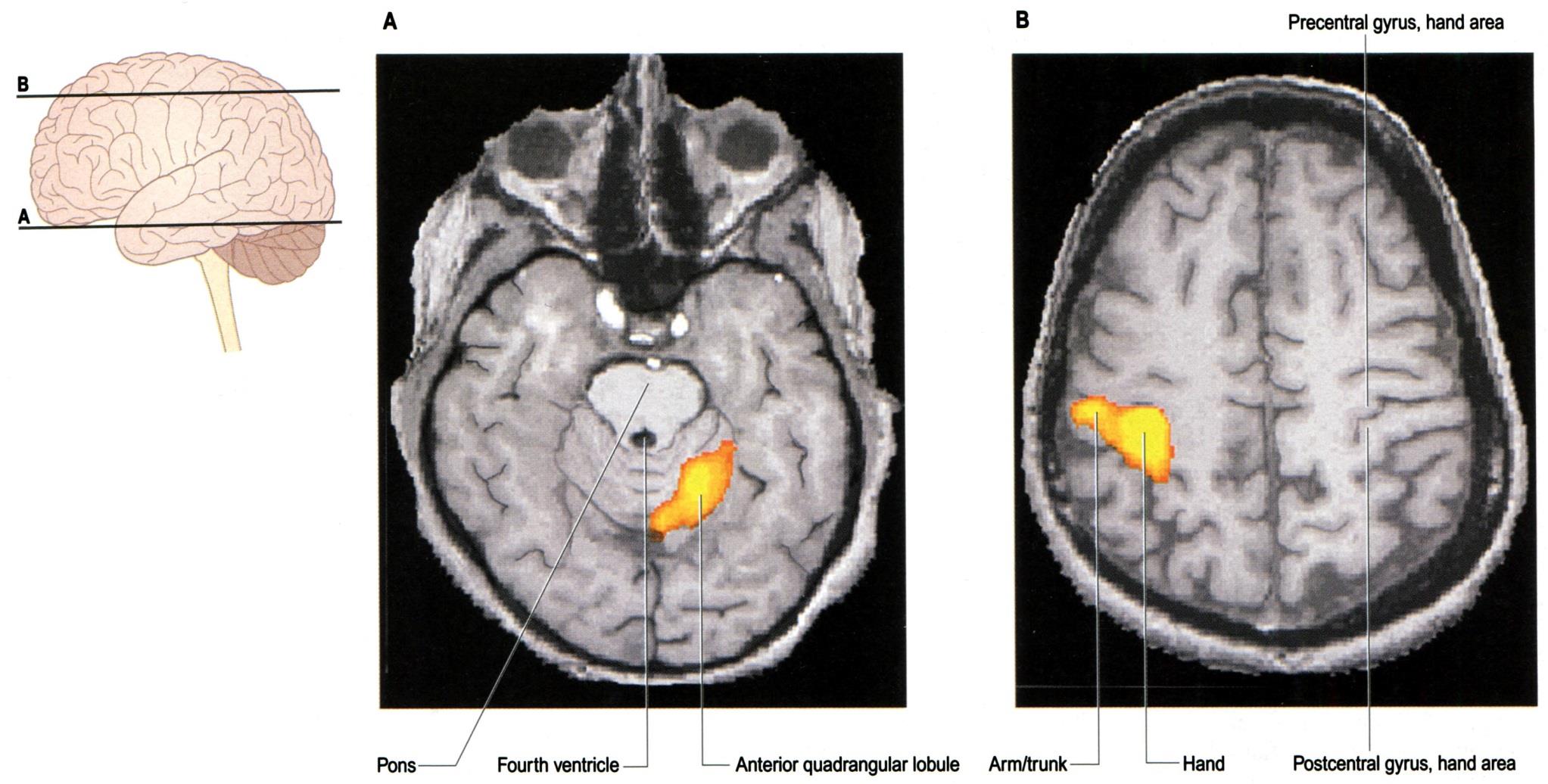 FUNKCIONÁLIS MRI A JOBB KÉZ UJJAINAK ISMÉTLŐDŐ