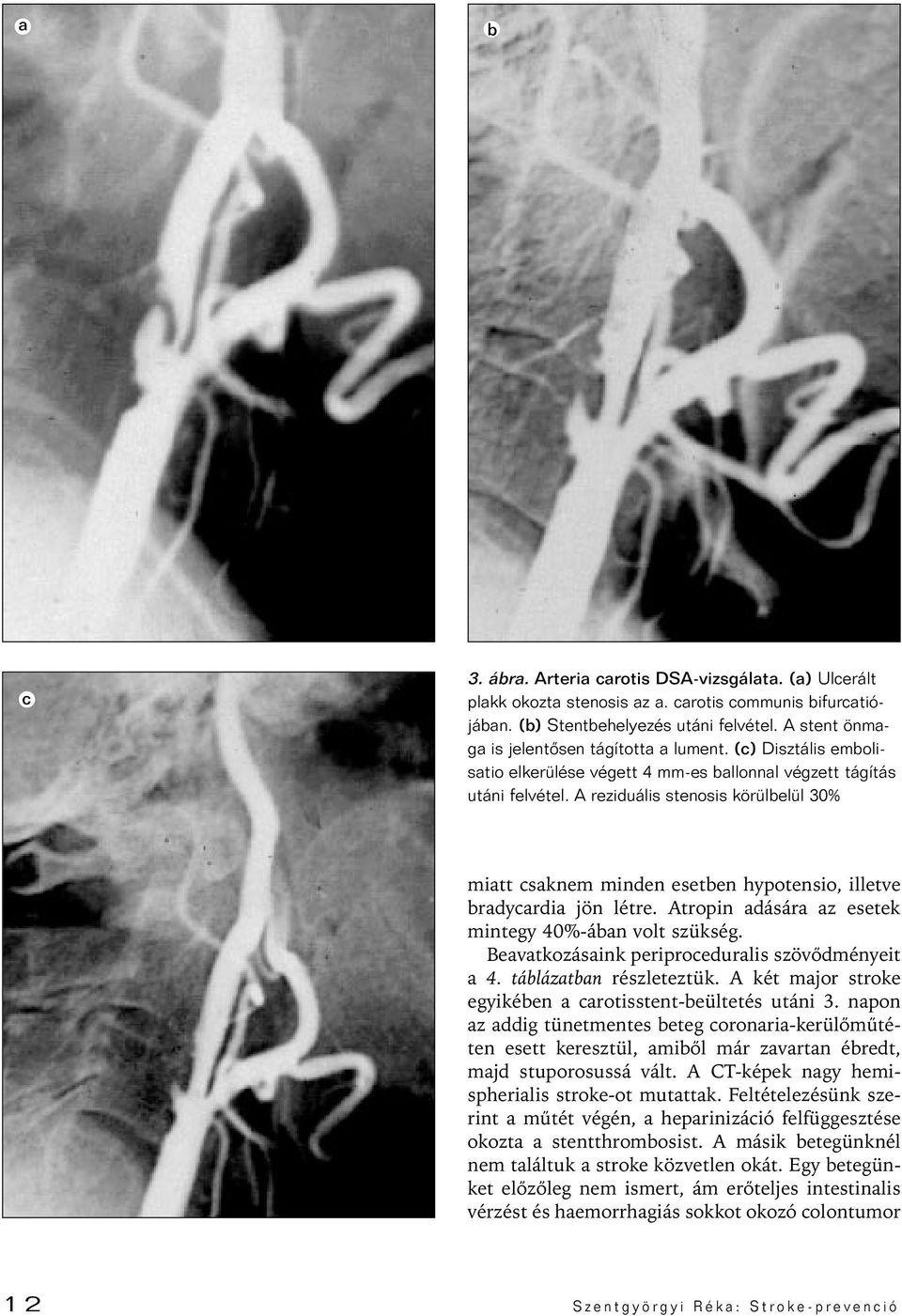 A reziduális stenosis körülbelül 30% miatt csaknem minden esetben hypotensio, illetve bradycardia jön létre. Atropin adására az esetek mintegy 40%-ában volt szükség.