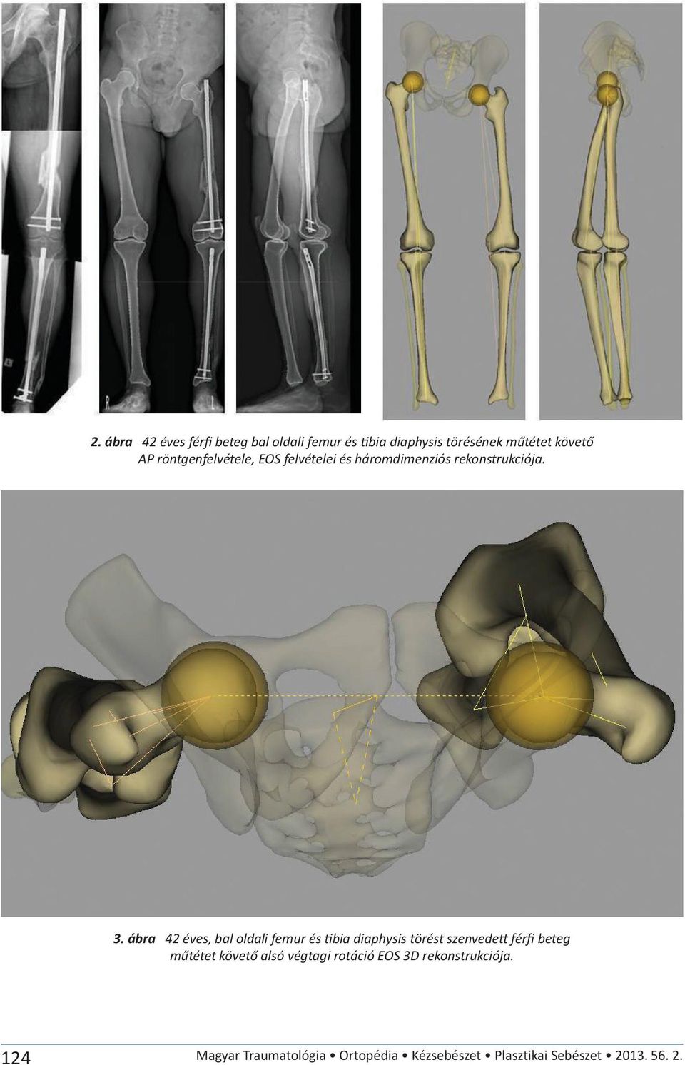 ábra 42 éves, bal oldali femur és tibia diaphysis törést szenvedett férfi beteg műtétet követő