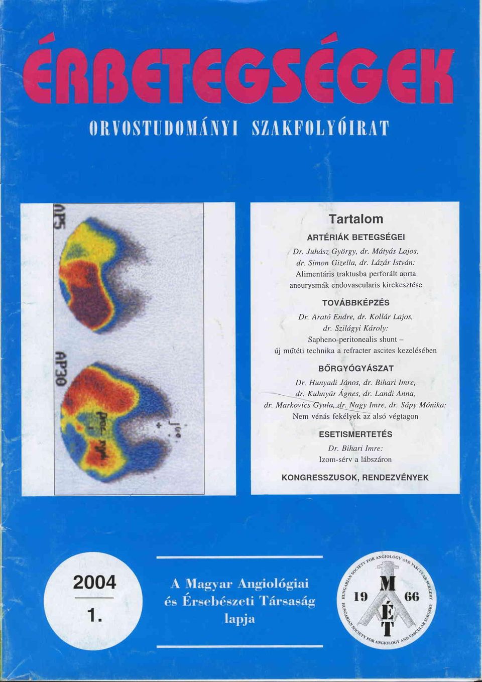 Szildgyi Kdroly; Sapheno-peritonealis shunt - rij mütdti technika a refracter ascites kezel6s6ben aöncvöcyäszat Dr. Hunyadi Jdnos, dr.