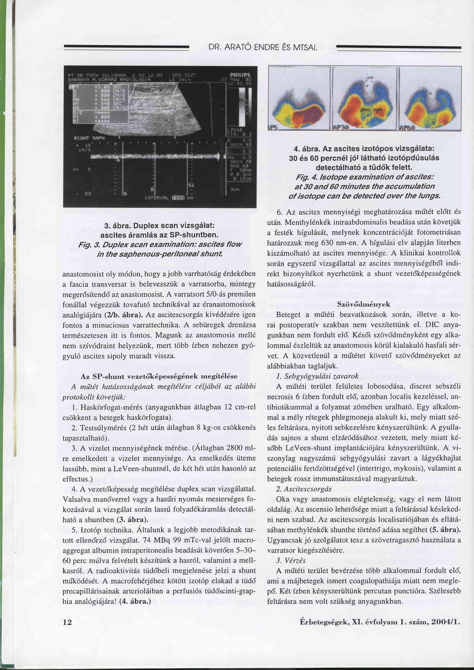 äbra. Duplex scan vizsgälat: ascites äramläs az SP-shuntben. Fig. 3.