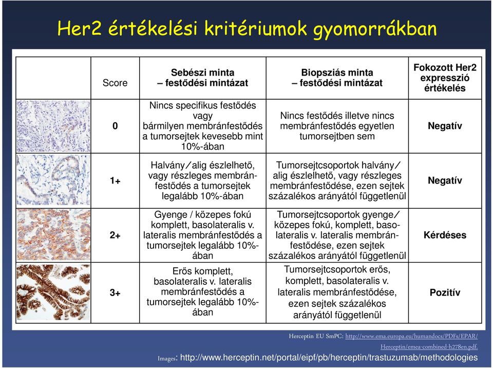 tumorsejtek legalább 10%-ában Tumorsejtcsoportok halvány alig észlelhető, vagy részleges membránfestődése, ezen sejtek százalékos arányától függetlenül Negatív 2+ Gyenge / közepes fokú komplett,