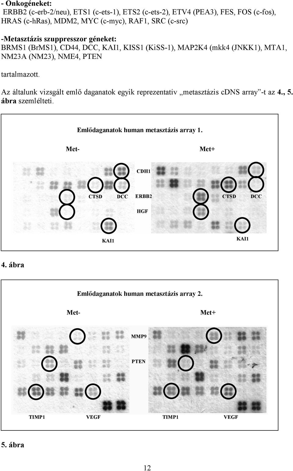 Az általunk vizsgált emlő daganatok egyik reprezentatív metasztázis cdns array -t az 4., 5. ábra szemlélteti. Emlődaganatok human metasztázis array 1.