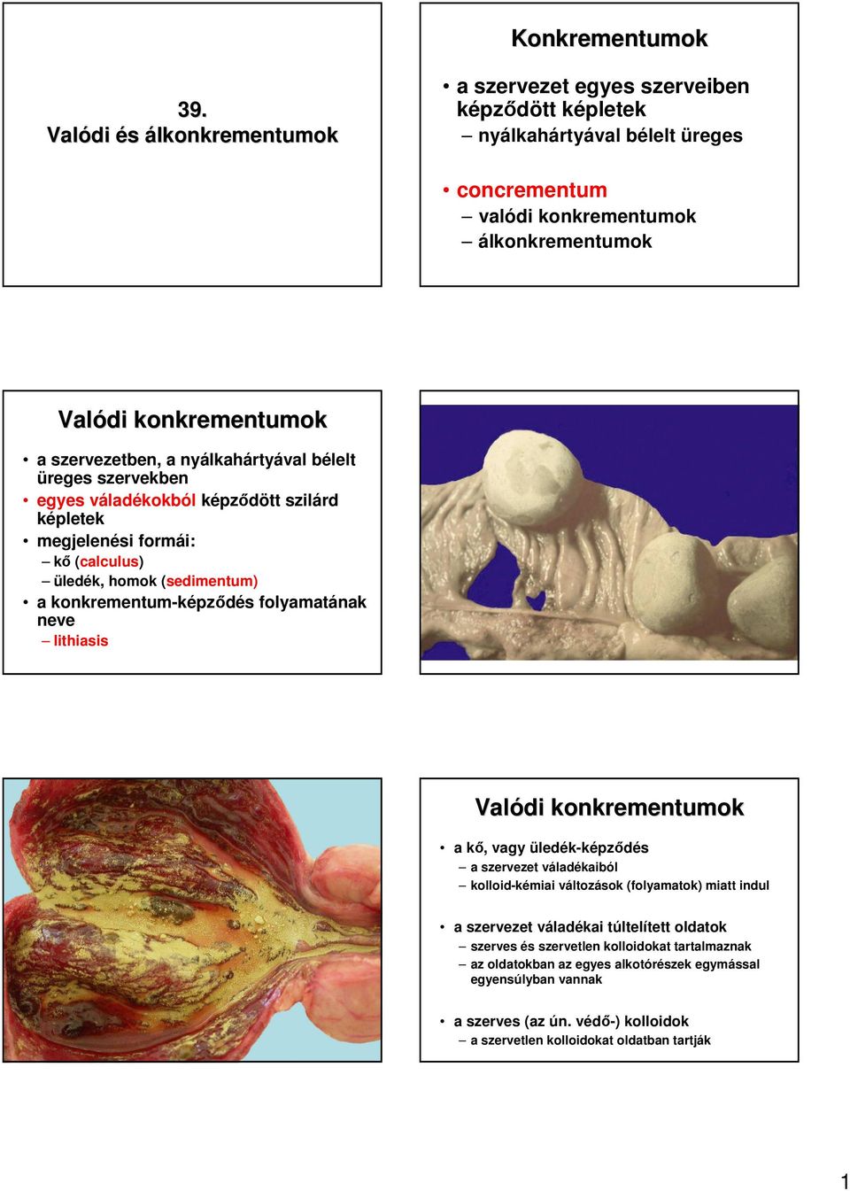 bélelt üreges szervekben egyes váladékokból képzıdött szilárd képletek megjelenési formái: kı (calculus) üledék, homok (sedimentum) a konkrementum-képzıdés folyamatának neve lithiasis