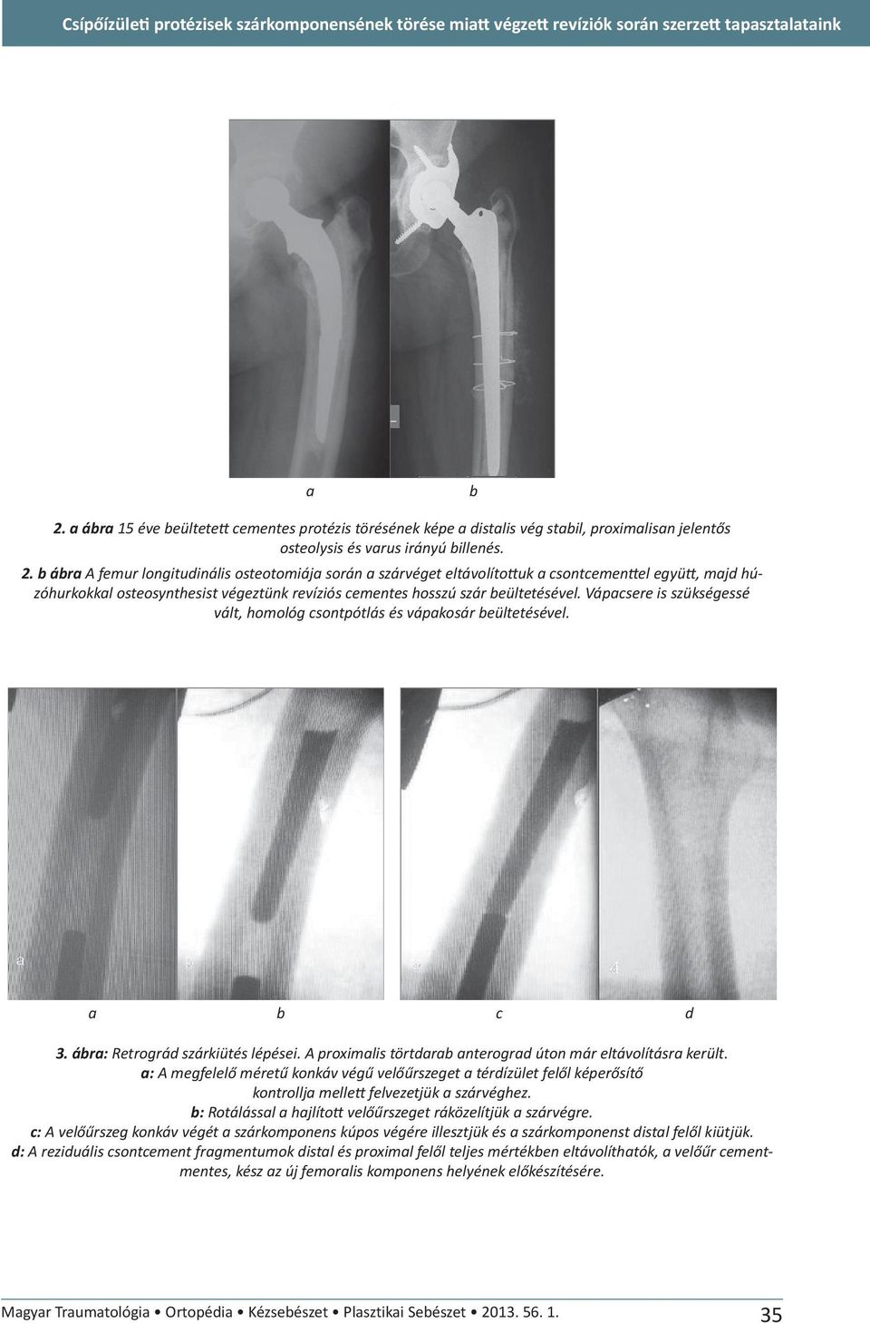 b ábra A femur longitudinális osteotomiája során a szárvéget eltávolíto uk a csontcemen el együ, majd húzóhurkokkal osteosynthesist végeztünk revíziós cementes hosszú szár beültetésével.