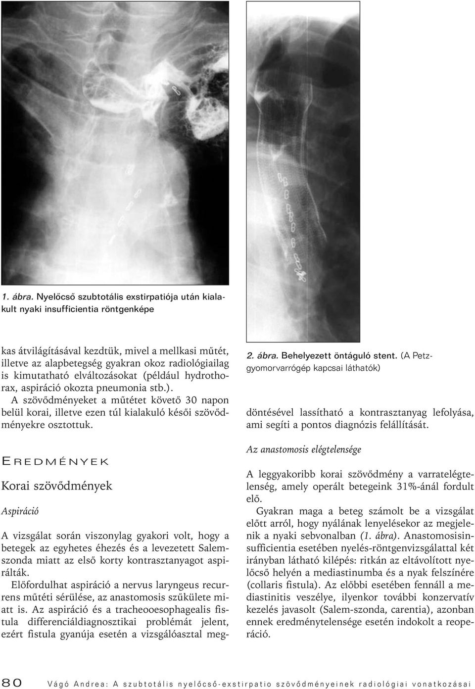 kimutatható elváltozásokat (például hydrothorax, aspiráció okozta pneumonia stb.). A szövôdményeket a mûtétet követô 30 napon belül korai, illetve ezen túl kialakuló késôi szövôdményekre osztottuk.