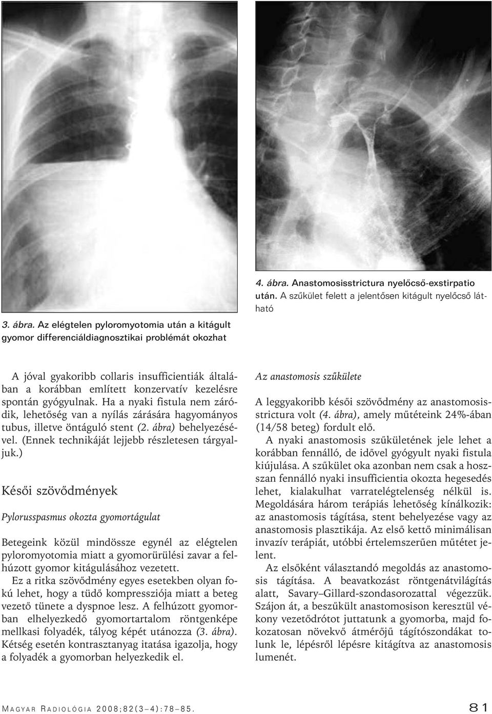 Ha a nyaki fistula nem záródik, lehetôség van a nyílás zárására hagyományos tubus, illetve öntáguló stent (2. ábra) behelyezésével. (Ennek technikáját lejjebb részletesen tárgyaljuk.