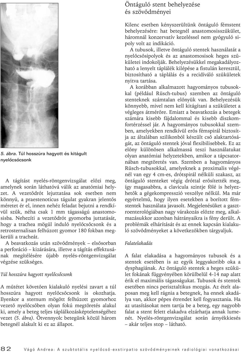 Nehezíti a vezetôdrót gyomorba juttatását, hogy a trachea mögül induló nyelôcsôcsonk és a retrosternalisan felhúzott gyomor 180 fokban megkerüli a tracheát.