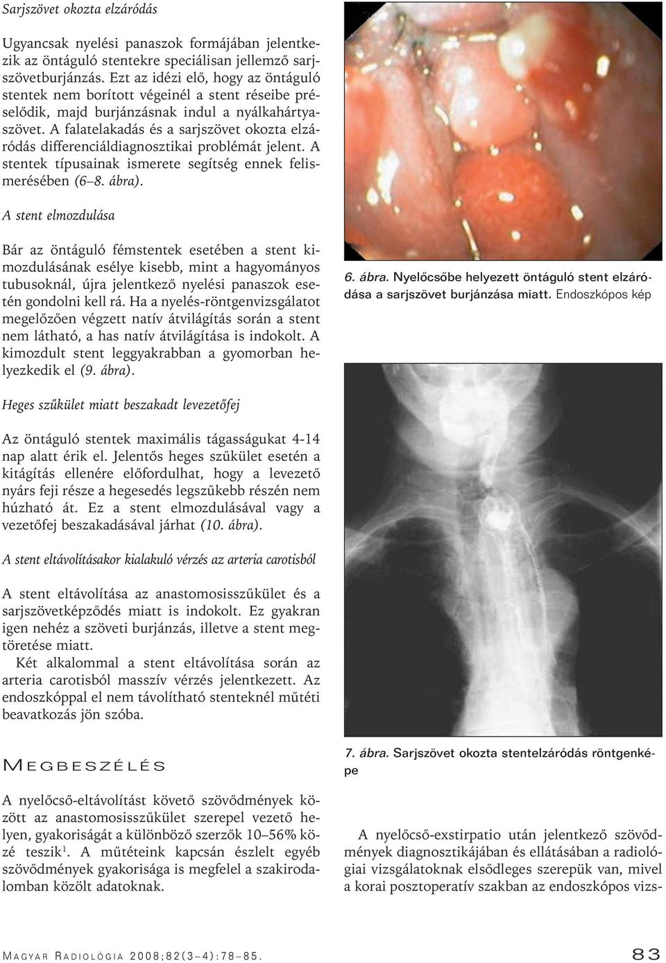 A falatelakadás és a sarjszövet okozta elzáródás differenciáldiagnosztikai problémát jelent. A stentek típusainak ismerete segítség ennek felismerésében (6 8. ábra).