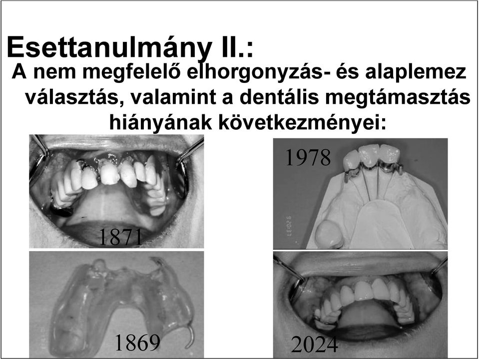 alaplemez választás, valamint a