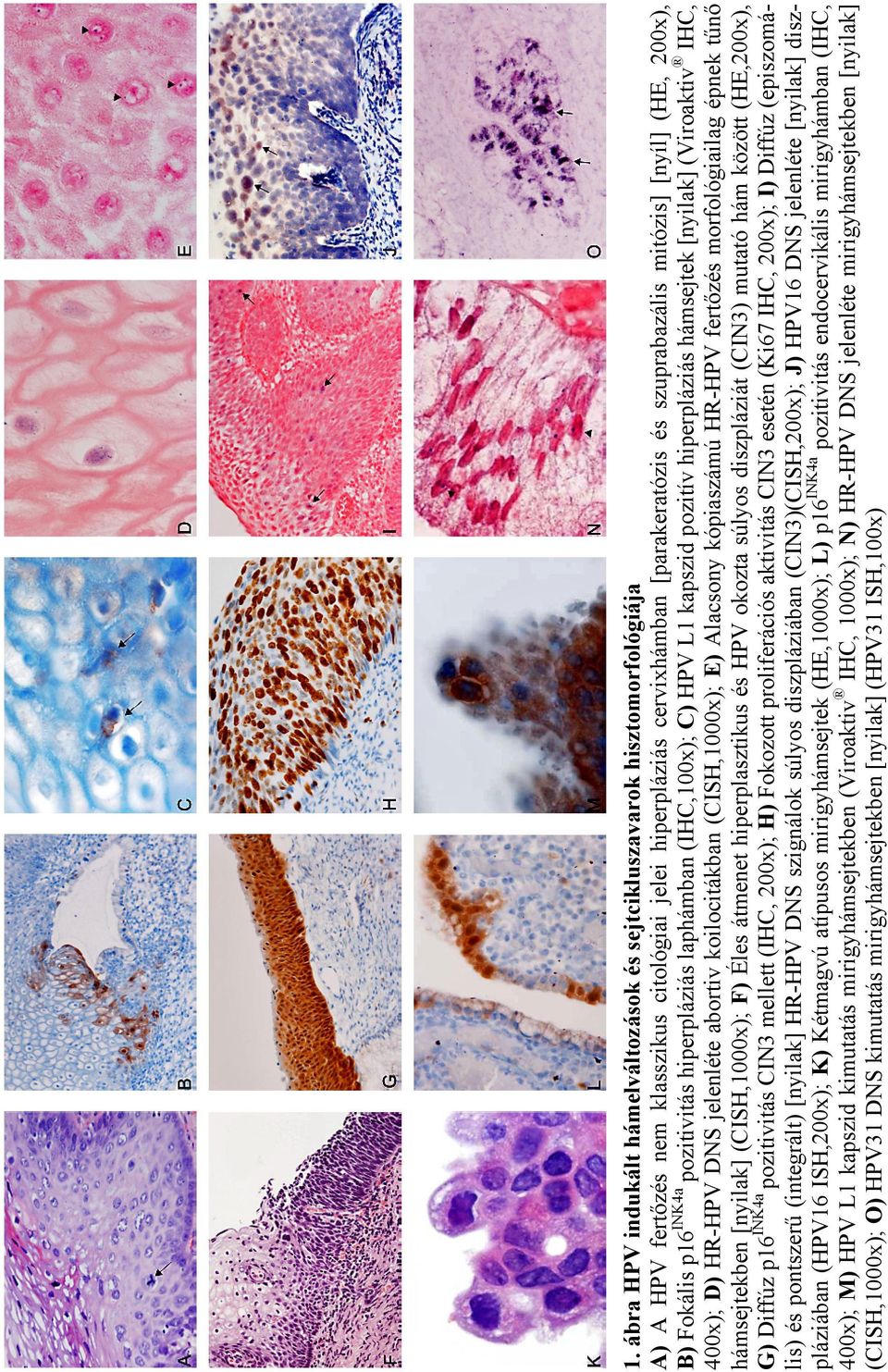 koilocitákban (CISH,1000x); E) Alacsony kópiaszámú HR-HPV fertőzés morfológiailag épnek tűnő hámsejtekben [nyilak] (CISH,1000x); F) Éles átmenet hiperplasztikus és HPV okozta súlyos diszpláziát