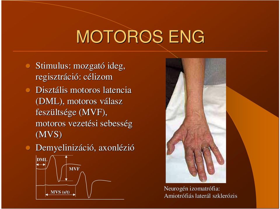 (MVF), motoros vezetési sebesség (MVS) Demyelinizáci ció, axonlézi zió