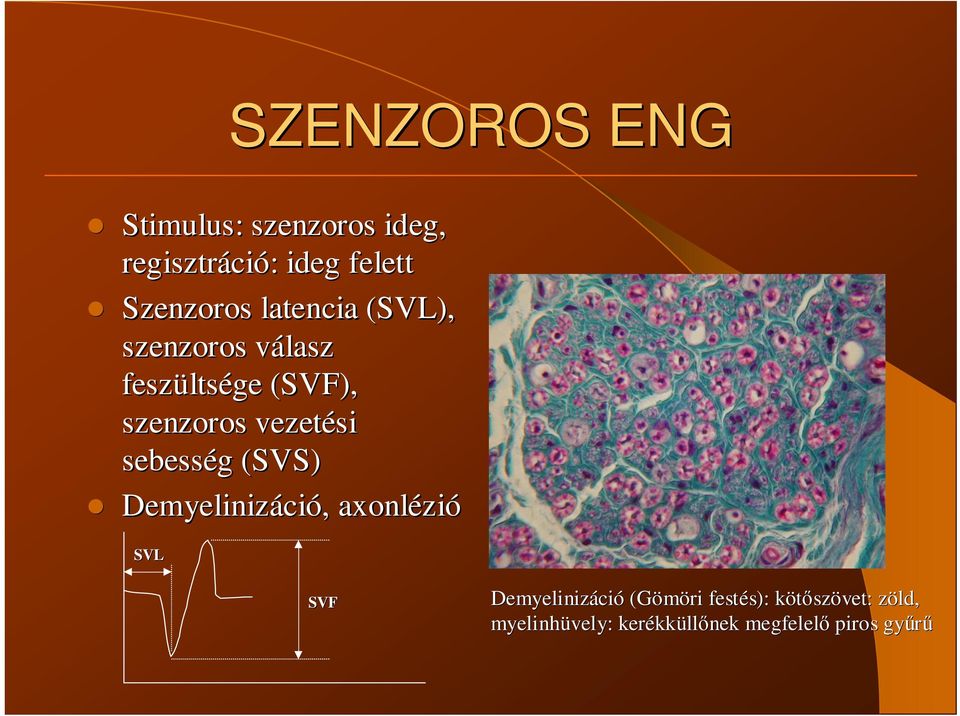 sebesség g (SVS) Demyelinizáci ció, axonlézi zió SVL SVF Demyelinizáci ció (Gömöri