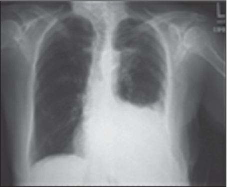 Infekció Koraszülöttek: meningitis járványok (NIC) 2003-ban kontaminált lipid tároló üvegek, vénás katéterek, tápoldatok, csapvíz nosocomiális pneumonia,vap, endocarditis, posztoperatív