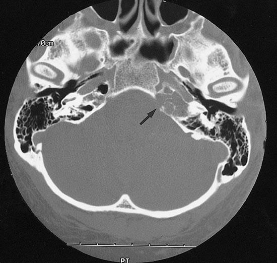 Pyramiscsúcs gennyedés, petrositis Gradenigo-syndroma: - akut otitis v.