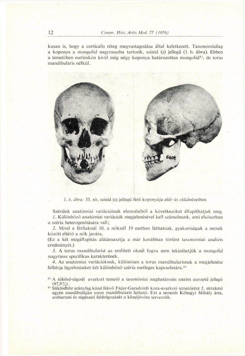 sír, szinid (s) jellegű férfi koponyája elöl- és oldalnézetben Szériánk anatómiai variációinak elemzéséből a következőket állapíthatjuk meg. 1.