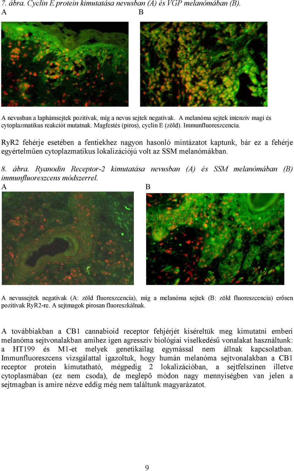 RyR2 fehérje esetében a fentiekhez nagyon hasonló mintázatot kaptunk, bár ez a fehérje egyértelműen cytoplazmatikus lokalizációjú volt az SSM melanómákban. 8. ábra.