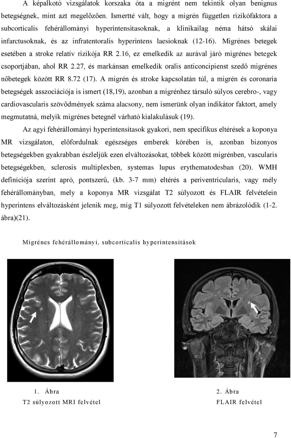 (12-16). Migrénes betegek esetében a stroke relatív rizikója RR 2.16, ez emelkedik az aurával járó migrénes betegek csoportjában, ahol RR 2.