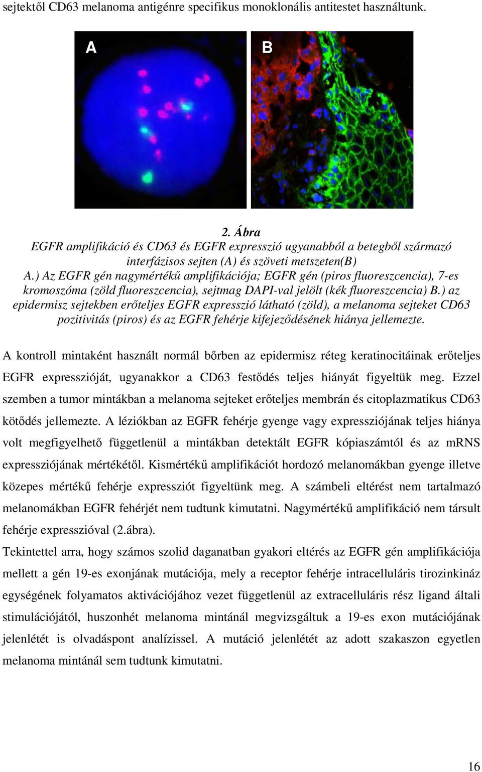 ) Az EGFR gén nagymértékő amplifikációja; EGFR gén (piros fluoreszcencia), 7-es kromoszóma (zöld fluoreszcencia), sejtmag DAPI-val jelölt (kék fluoreszcencia) B.