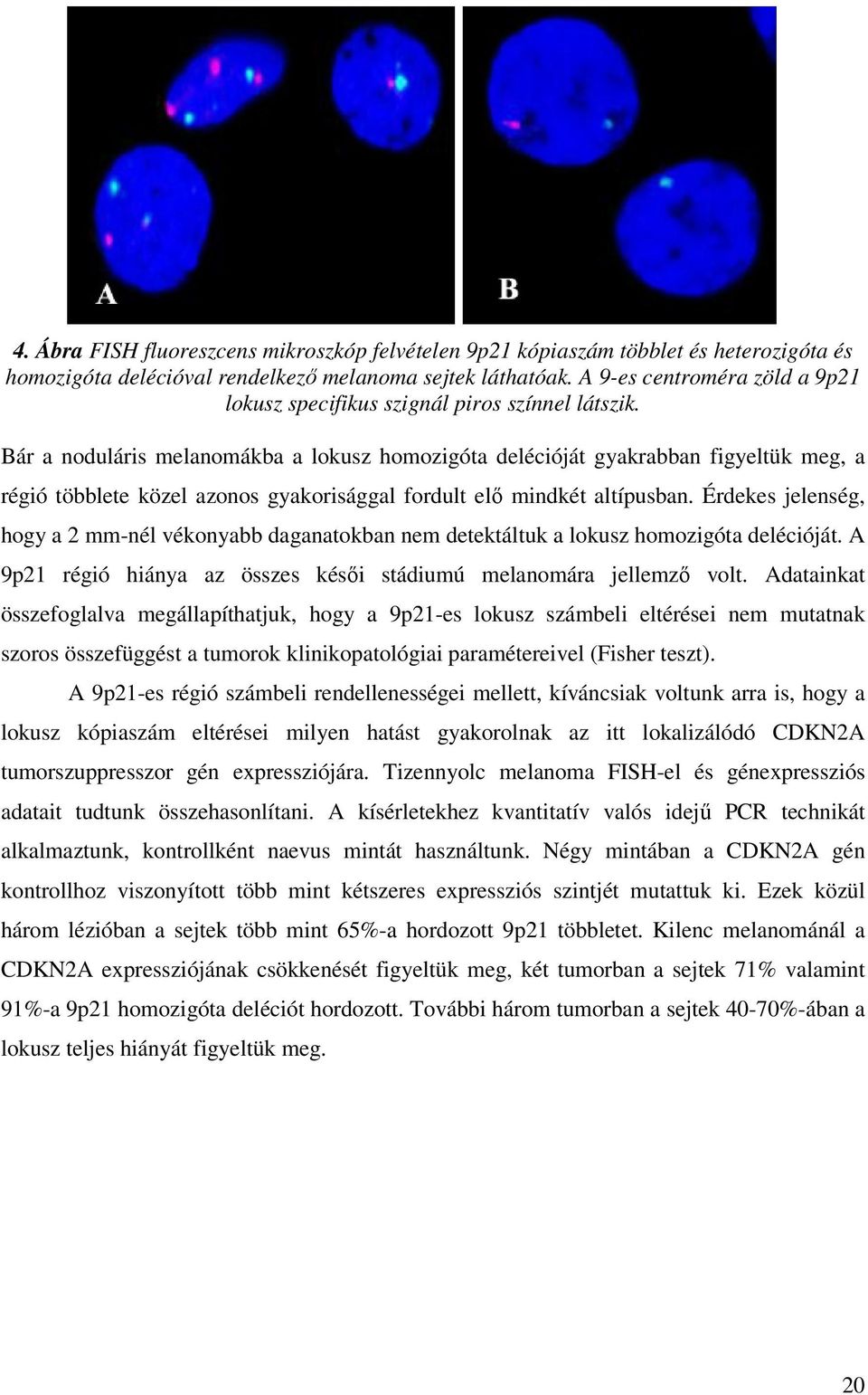 Bár a noduláris melanomákba a lokusz homozigóta delécióját gyakrabban figyeltük meg, a régió többlete közel azonos gyakorisággal fordult elı mindkét altípusban.