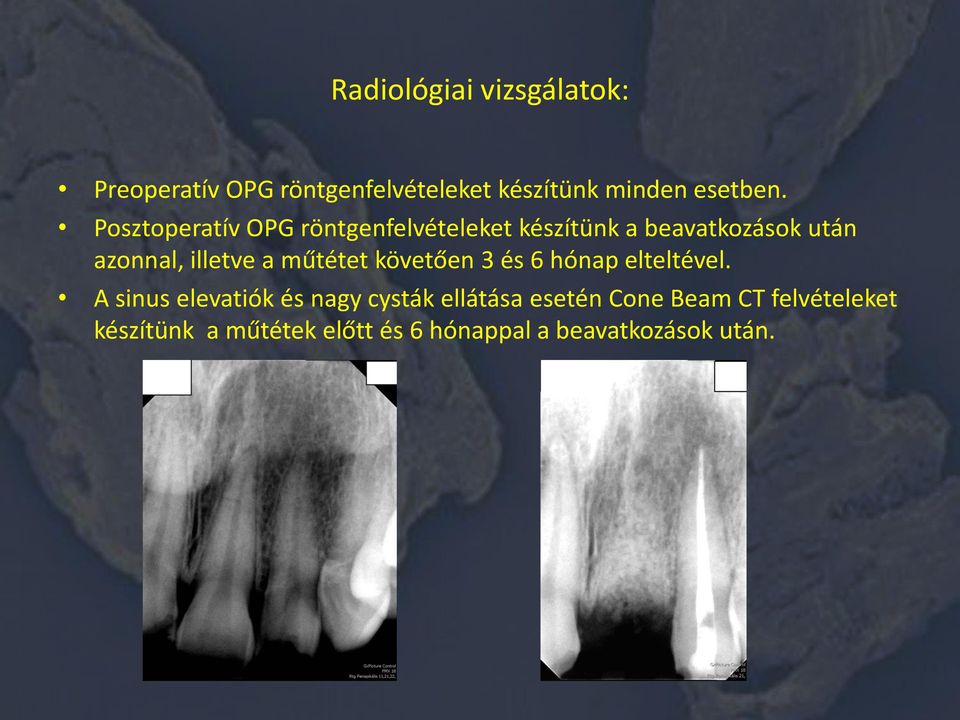 műtétet követően 3 és 6 hónap elteltével.