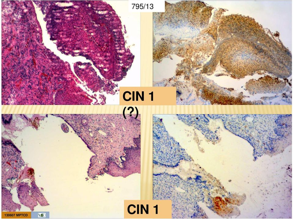 ) CIN 1