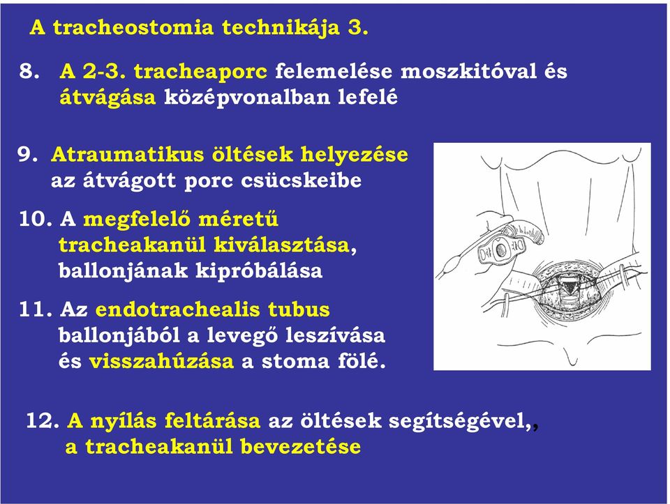 Atraumatikus öltések helyezése az átvágott porc csücskeibe 10.