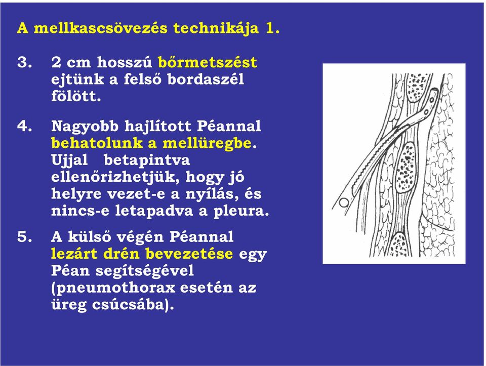 Nagyobb hajlított Péannal behatolunk a mellüregbe.