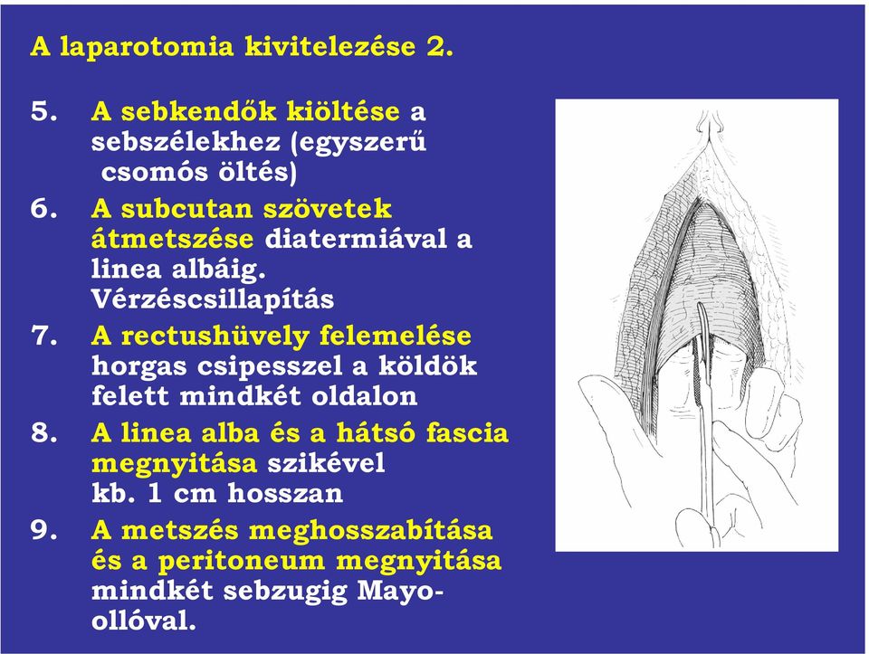 A rectushüvely felemelése horgas csipesszel a köldök felett mindkét oldalon 8.