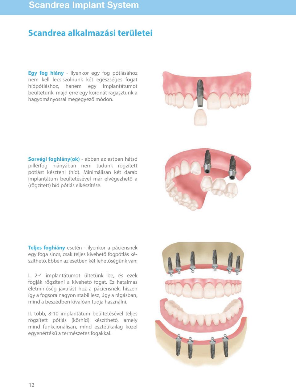 Minimálisan két darab implantátum beültetésével már elvégezhető a (rögzített) híd pótlás elkészítése.