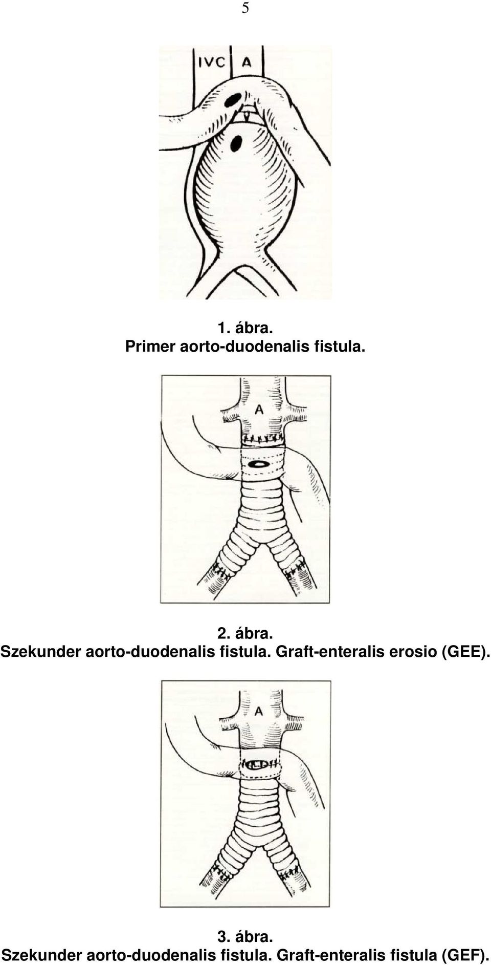 Graft-enteralis erosio (GEE). 3.