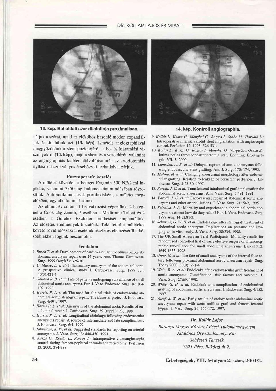 , Hontdth L: Intraoperative internal carotid stent implantation with angioscopic control. Pertusion 12, 1998. 526-531. 10. Kollär L., Kasza G., Rozsos 1., Menyhei G., Varga 7-s.