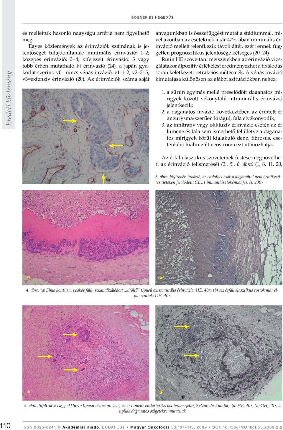 szerint: v0= nincs vénás invázió; v1=1 2; v2=3 5; v3=extenzív érinvázió (20).
