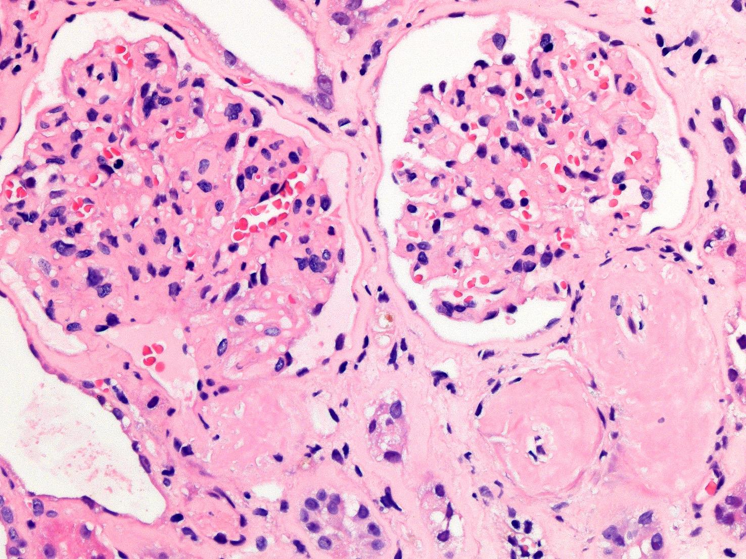 Amyloid: homogén