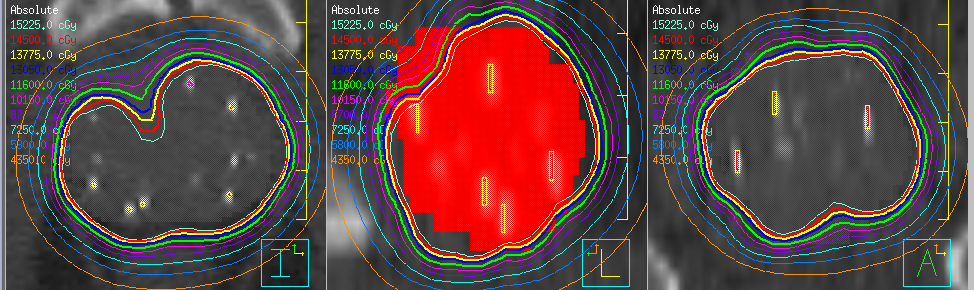 volt, a seed-ek átlagos aktivitása pedig 0,529 mci. Az elhelyezett seed-ek, és a kialakuló dózistér a következő ábrán látható: 5.3.1. ábra.