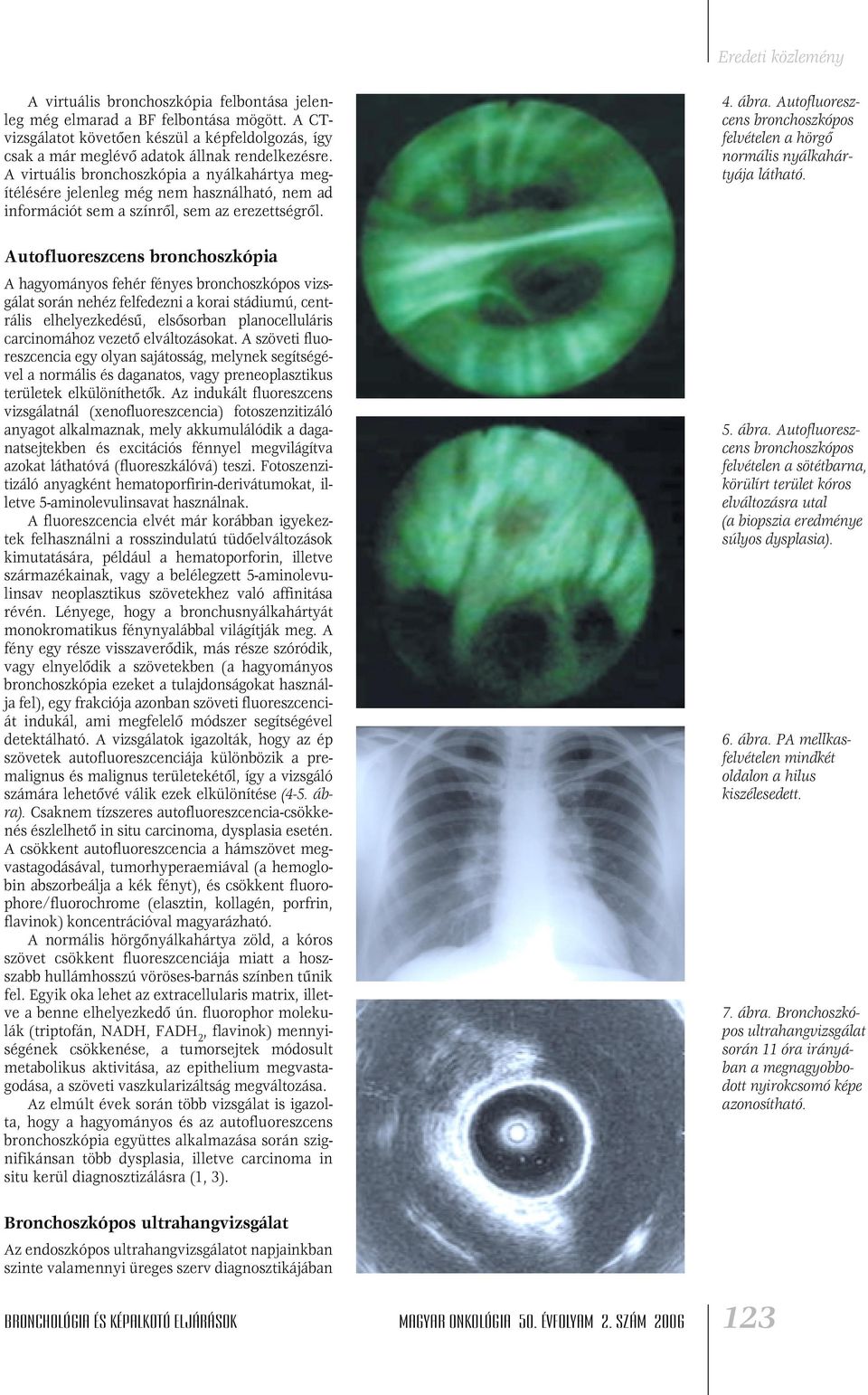 Autofluoreszcens bronchoszkópia A hagyományos fehér fényes vizsgálat során nehéz felfedezni a korai stádiumú, centrális elhelyezkedésû, elsôsorban planocelluláris carcinomához vezetô elváltozásokat.