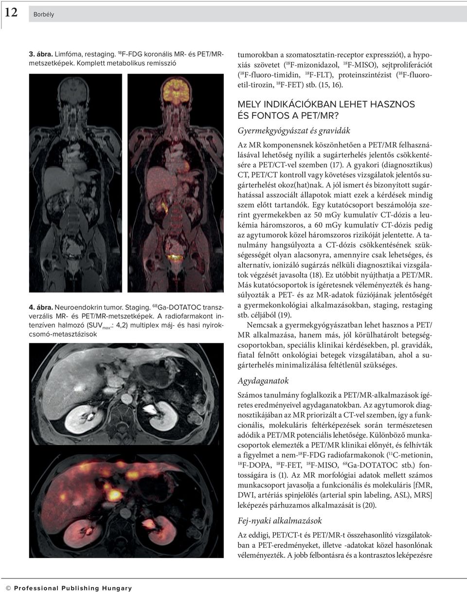 : 4,2) multiplex máj- és hasi nyirokcsomó-metasztázisok tumorokban a szomatosztatin-receptor expresszió t), a hypo - xiás szövetet ( F-mizonidazol, F-MISO), sejtproliferációt ( F-fluo ro-timidin,