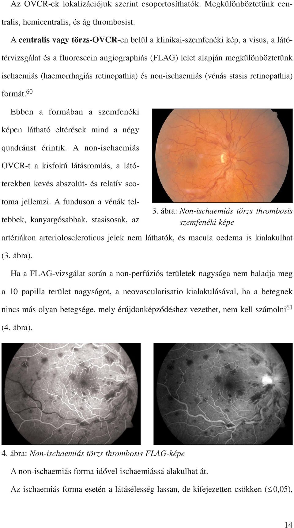 retinopathia) és non-ischaemiás (vénás stasis retinopathia) formát. 60 Ebben a formában a szemfenéki képen látható eltérések mind a négy quadránst érintik.