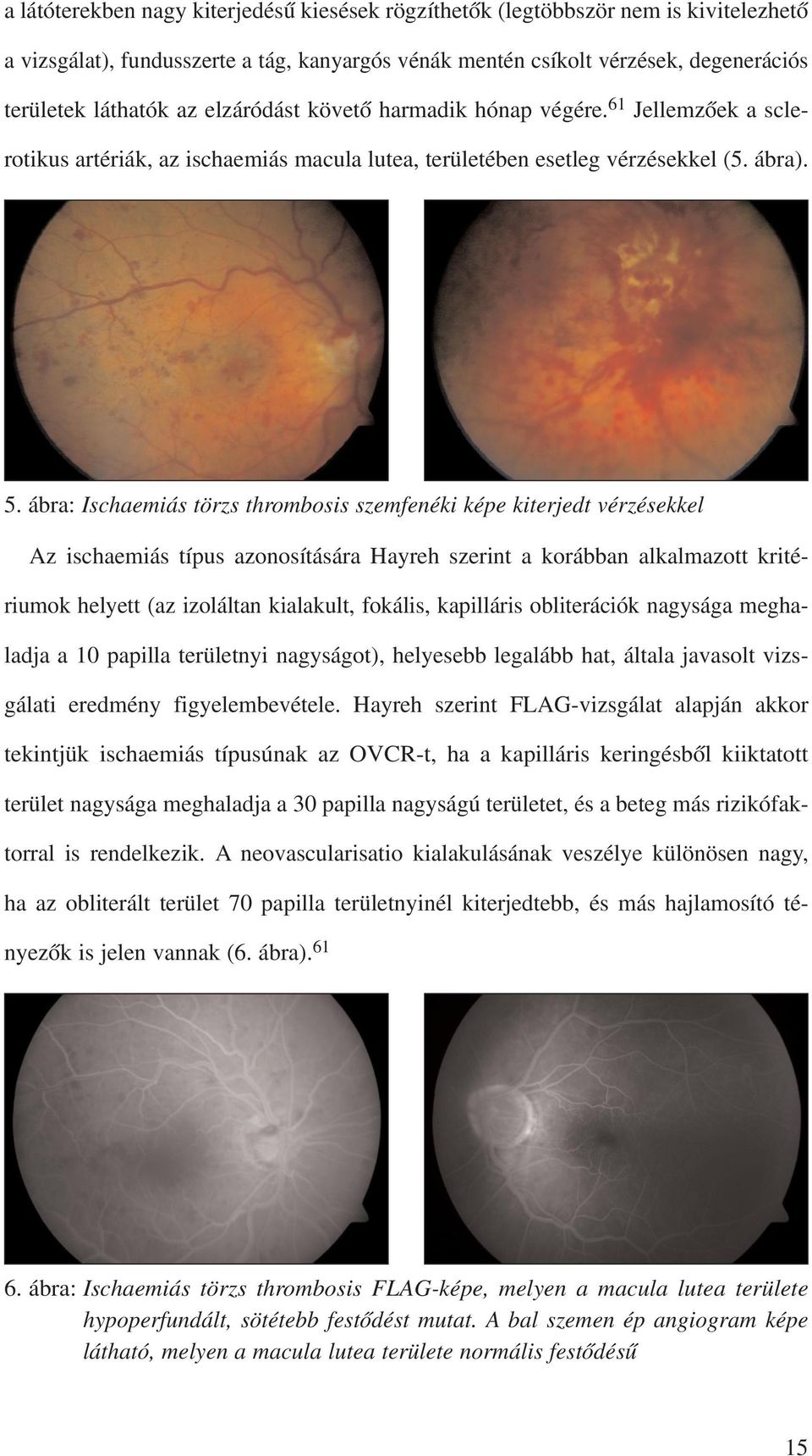 ábra: Ischaemiás törzs thrombosis szemfenéki képe kiterjedt vérzésekkel Az ischaemiás típus azonosítására Hayreh szerint a korábban alkalmazott kritériumok helyett (az izoláltan kialakult, fokális,