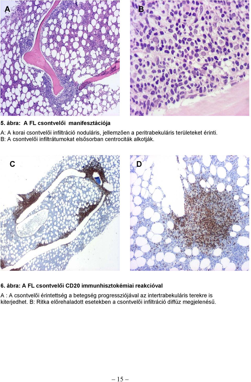 területeket érinti. B: A csontvelői infiltrátumokat elsősorban centrociták alkotják. C D 6.