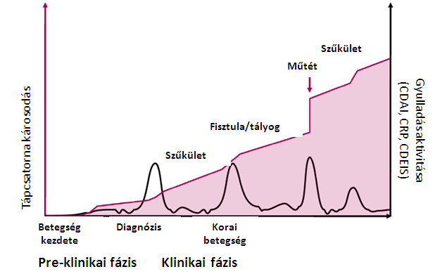 Crohn-betegség: