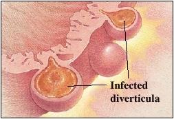 Diverticulitis pathofiziológia Divertikulum szájadék obstrukciója