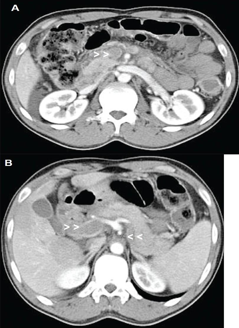 Polycytaemia rubra vera első portalis hypertonia, sec. v. lienalis thrombosissal felismerése http://www.gfmer.ch/genetic_diseases_v2/gendis_detail_list.php?cat3=2194 Idősebbek, férfiakban min.