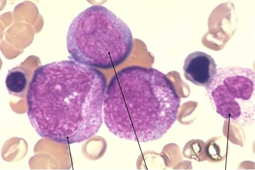 Csontvelőkép, myelocyták promyelocyta myelocyta