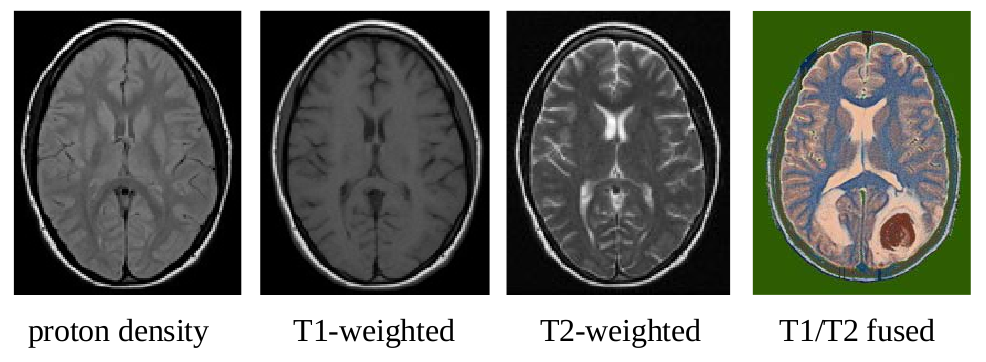 Mágneses gerjesztés Mágneses relaxáció MRI szekvenciák Különböz súlyozott kép összehasonlítása Koponya MRI vizsgálat esetén T1: