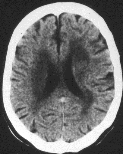 Lacunaris infarctus kis perforátor erteria occlusio Diffúz