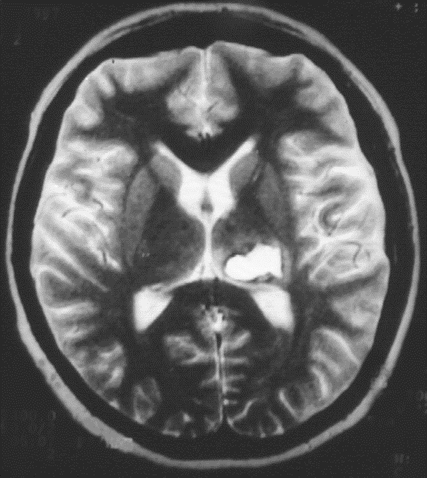 CEREBROVASZKULÁRIS KÓRKÉPEK Haemorrhagiás