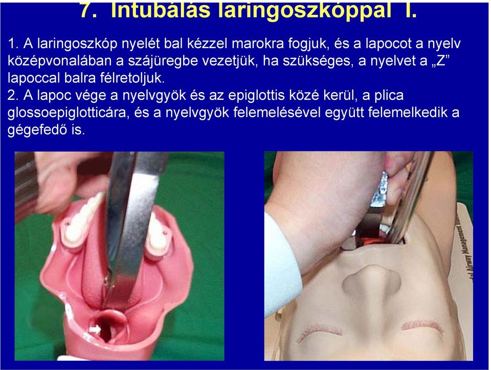 szájüregbe vezetjük, ha szükséges, a nyelvet a Z lapoccal balra félretoljuk. 2.