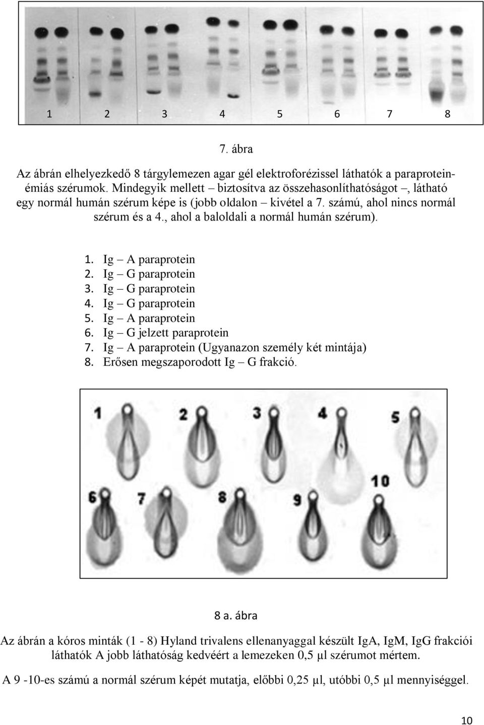 , ahol a baloldali a normál humán szérum). 1. Ig A paraprotein 2. Ig G paraprotein 3. Ig G paraprotein 4. Ig G paraprotein 5. Ig A paraprotein 6. Ig G jelzett paraprotein 7.